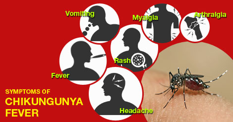 chikungunya-fever