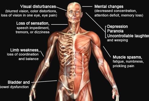 multiple-sclerosis-s11-ms-symptoms